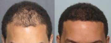 An afro hair transplant is transferring follicular units from a healthy donor area at the back of the head to the area suffering from hair loss. Men S African American Hair Transplant Dr Sean Behnam