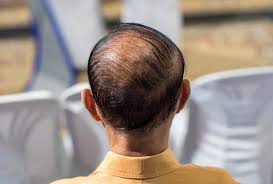 List of the best hair serum available in india with price. à¤¹ à¤¯à¤° à¤¸ à¤°à¤® à¤• à¤¯ à¤¹ à¤œ à¤¨ à¤¹ à¤¯à¤° à¤— à¤° à¤¥ à¤• à¤² à¤ à¤‡à¤¸ à¤²à¤— à¤¨ à¤• à¤¸à¤¹ à¤¤à¤° à¤• How To Use A Hair Serum The Do S And Don Ts In Hindi