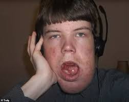 Man born with rare condition that made face deformed reveals he can lose  ability to speak to fix it