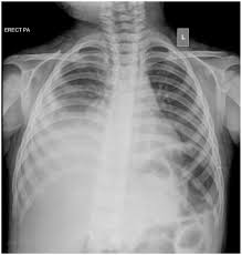 A pleural effusion is the accumulation of fluid between the layers of pleura that cover the lung. An Unusual Association Of Pleural Effusion With Acute Viral Hepatitis Phmt
