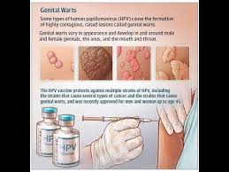 Image result for genital warts