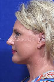 Facial Plastic Surgery Oklahoma City