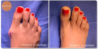 Cosmetic surgery is performed to reshape the appearance of body parts. Before After Bunion Surgery Photo Gallery Los Angeles Foot Doctor Beverly Hills