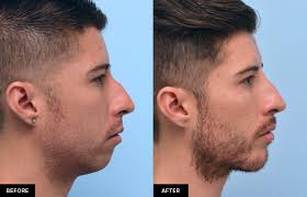 Like any other muscles in your body, your jawline's own muscles can be toned with proper exercise. Defining The Jaw Jawline With Fillers In San Francisco Dr David Mabrie Mabrie Facial Institute