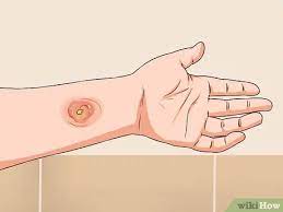 Nationwide team of wonderful doctors. 4 Ways To Get Rid Of Mrsa Wikihow