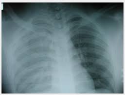Image result for Hemothorax