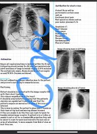 Image result for Chest XRay Interpretation