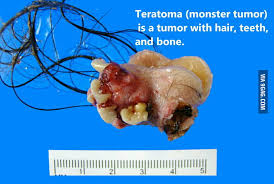 See more ideas about archangels, dermoid cyst, ovarian cyst symptoms. Teratoma A K A Monster Tumor 9gag