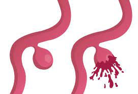 Brain Aneurysm - Symptoms And Causes - Mayo Clinic