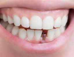 We did not find results for: Dental Implants South Burlington Dental Implants Green Mountain Dental