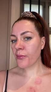 Efter en SKINPEN behandling 😝, #skinpen #skinpenmicroneedling #akne  #aknear #glathud #nyhud #hudfornyelse #microneedling #vesterbro  #ingenmakeup #skønhedsklinik