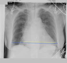 Lesson Title Enlarged Heart This is the best way to check for imaging is recommended to improve diagnosis, prognosis and guide potential therapies in cvrd. lesson title enlarged heart