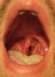 Image result for Strep throat infection roof of mouth