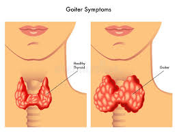 Image result for Multinodular Goiter