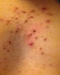 Zu Viele Pickel Und Anderes Auf Der Brust Sollte Ich Den Hautarzt Kontaktieren Hautpflege