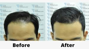 ˈkuˈala ˈtəˈrəŋˈganu), often abbreviated as k.t., is a city, the administrative capital, royal capital and the main economic centre of terengganu, malaysia. Hair Transplant Malaysia
