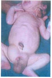 Image result for Inguinal hernia child