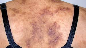 Image result for skin rash acute hiv infection