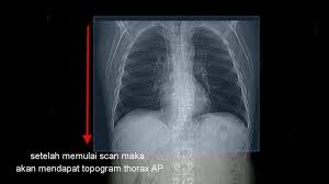 Pengertian trauma thorax adalah semua ruda paksa pada thorax dan dinding thorax, baik trauma atau pneumotorax adalah terdapatnya udara dalam rongga pleura, sehingga. Teknik Pemeriksaan Ct Scan Thorax Youtube