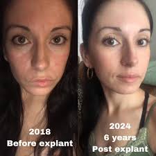 Did anyone else have the skin condition rosacea with implants? Did it clear  up after explant. I e had it for over a year it's starting to make me  really self conscious |