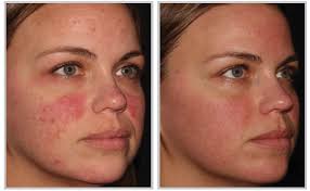 We did not find results for: Halo Laser The Facebar