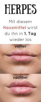 Ich habe die die grippe hingegen verläuft wesentlich schneller und stärker in ihren symptomen. Pin On Ernahrung
