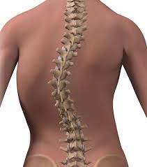 Infantile scoliosis occurs before age 3 and is seen more in the most common type (right thoracic), the right shoulder is consistently rotated forward and the medial border of the right scapula protrudes posteriorly. Muscular Imbalance Why Does Scoliosis Create One Weak Side