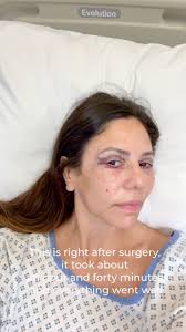 3 months ago I made the decision to do something about my very droopy  eyelids and booked in for blepharoplasty (still can't say that word!) with  @drmaurizioviel @cornerstoneclinics