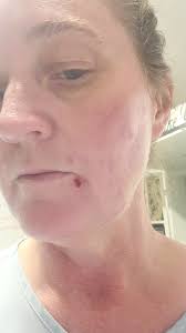 Investigation into Morgellons disease and its possible connection to UFO  emissions and alien nanotechnology