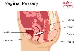 Image result for Pessary