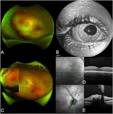 Frontiers | Acute Retinal Necrosis: Clinical Features, Diagnostic Pitfalls,  Treatment, and Outcome of an Insidious Disease in Children. Case Report and  Review of the Literature