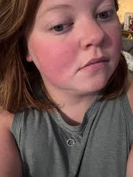 Hey group! Does anyone here have psoriasis arthritis and celiac? I would  love to pick your brain please. I have been suffering the last year and a  half with a mystery autoimmune