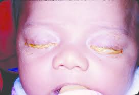 Image result for Gonococcal Conjunctivitis