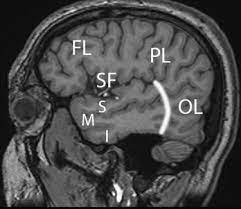 Magnetic Resonance Imaging Of The Temporal Lobe Normal Anatomy And Diseases Sciencedirect