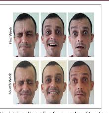 Feb 01, 2016 · exercises. Pdf Treatment Of Bell Palsy Using Facial Exercises In Primary Health Care A Case Report Semantic Scholar
