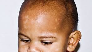 Image result for yellow scabs on the face in children