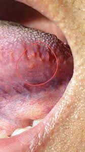 Image result for papillomavirus tongue)