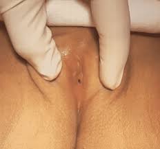 Image result for Labial Fusion