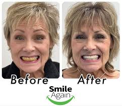 Single & Full-Arch Dental Implants |