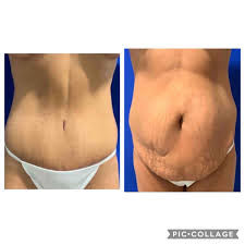 Tummy Tuck With Liposuction Liposuction Tummy Tucks Cosmetic Surgery