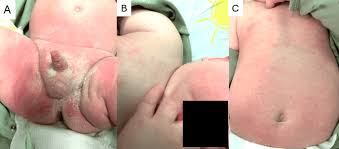 Image result for diaper dermatitis