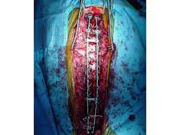 We did not find results for: Scoliosis Research Post Surgical Improvement