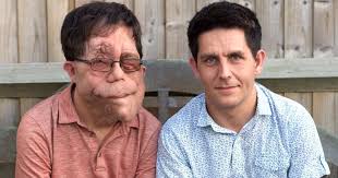 Agony of identical twins born with rare genetic disease that has left one  of them with huge tumours