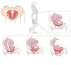 Prolapse When The Pelvic Floor Collapses An Informative Article With Great Illustrations From Pelvic Floor Pelvic Floor Dysfunction Pelvic Floor Prolapse