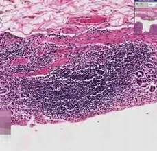 Histopathology Stomach Chronic Gastritis Rocks And Crystals Crystals Crafts