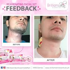 Brilliant Skin Essentials Main Office - Before and After using Brilliant Rejuvenating Facial Set. 🔥 Laki ng pinag bago ng skin ni Kuys diba? Kahit gaano kadami pa ang tagyawat mo kayang