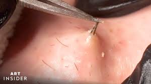 When infected, they can grow to become abscesses or boils. How Ingrown Hairs Are Removed Youtube