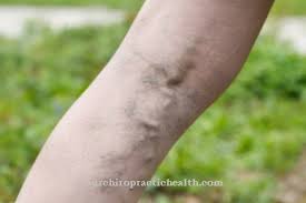 Vena varikos mungkin berulang dengan perawatan. Phlebology Rawatan Kesan Risiko Rawatan