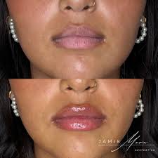 Schedule your appointment with Jamie Mora, PA-C @Studiophilly Link in my  bio 267-586-4978 Hablo Español 🇨🇴 Treatments/Pricing -SKINVIVE