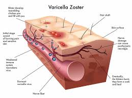 Image result for Varicella zoster on human skin